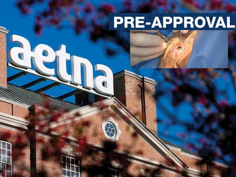 Aetna policy change requires preapproval for cataract surgeries