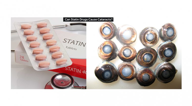 Can Statin Drugs Cause Cataracts?