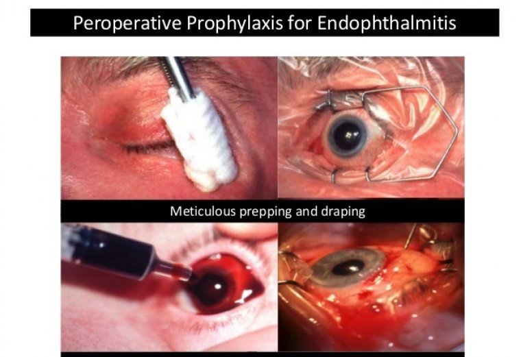Cataract Prophylaxis, Treatment & Pharmacological Approaches