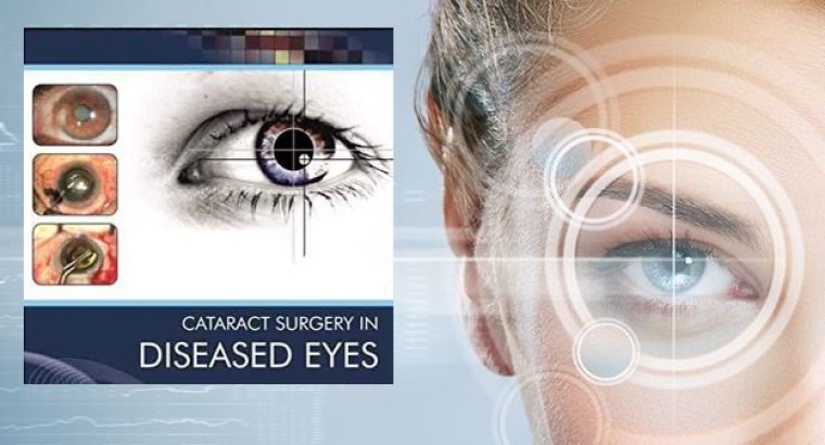 Cataract Surgery & Diseased Corneas