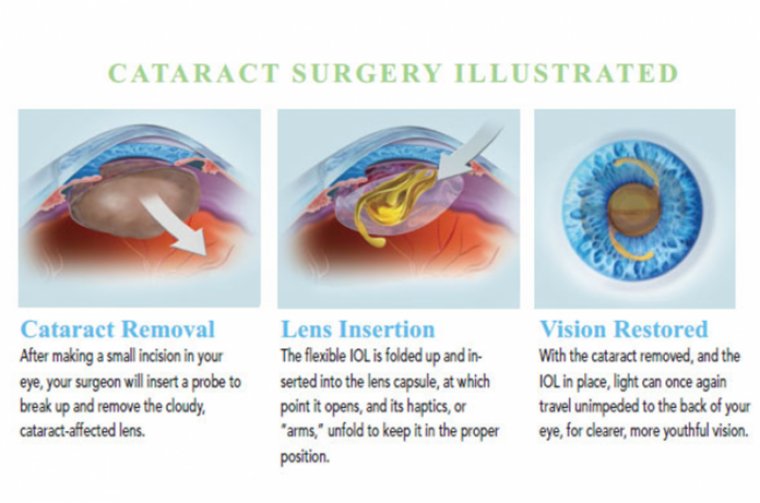 Cataract Surgery & Dropless – Perioperative Treatments