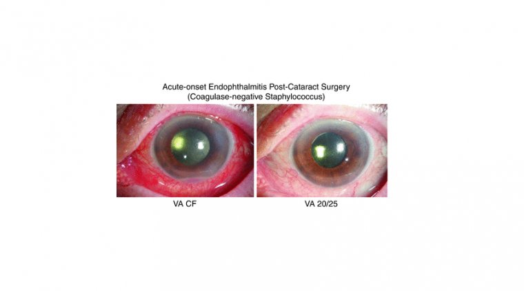 Endophthalmitis Risk Can Increase After Cataract Surgery 