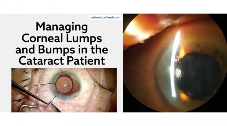 Cataract Surgery in Complex Corneas 