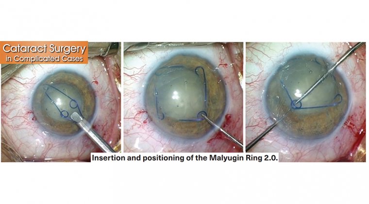 Cataract Surgery in Complex Pathology