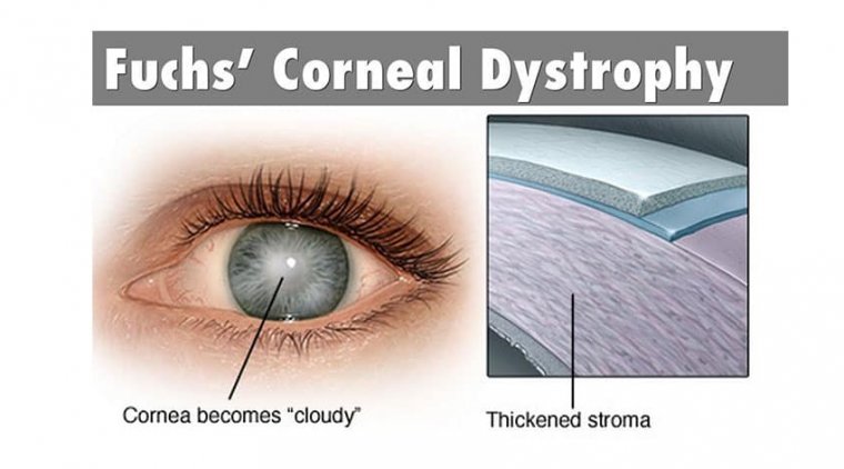 Cataract Surgery & IOL Placement in Patients With Fuchs Corneal Dystrophy