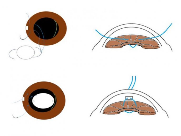 Cataract Surgery & Iris Fixation IOL Technique