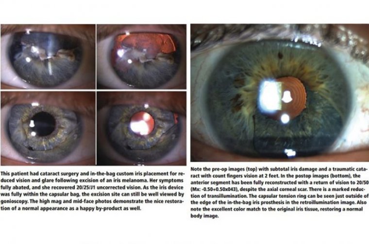 Cataract Surgery & Iris Prostheses