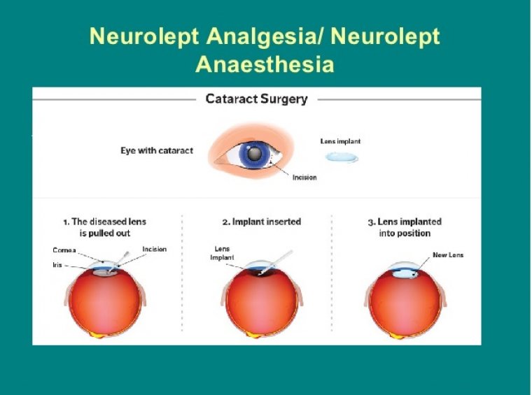 Cataract Surgery & Neurolept Anesthesia