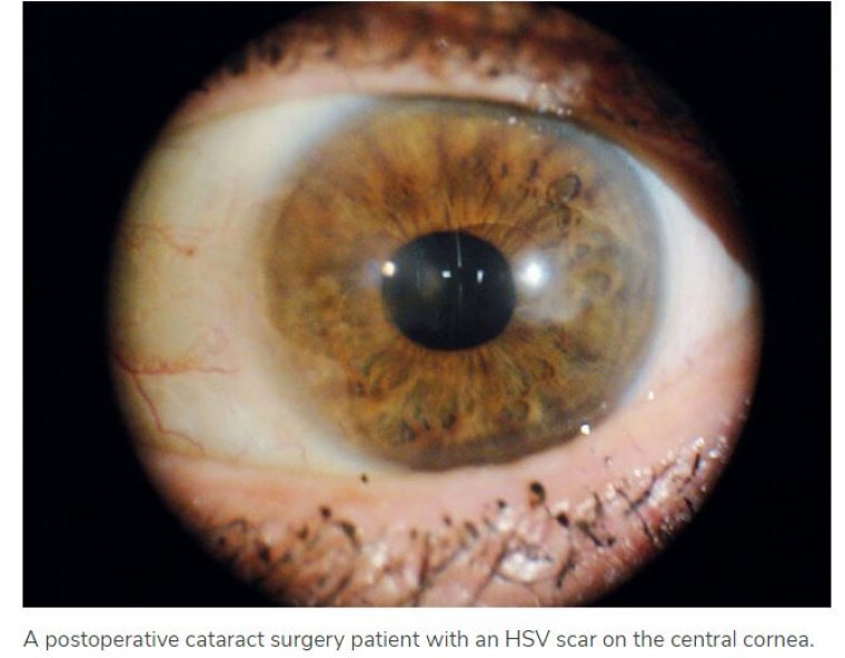 Cataract Surgery & Patients With Herpetic Disease