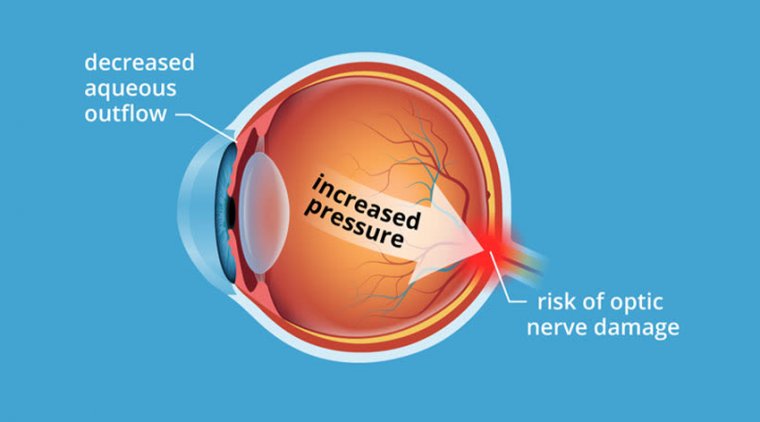 Cataract Surgery - Preop IOP hints & Elevated Post Surgery IOP