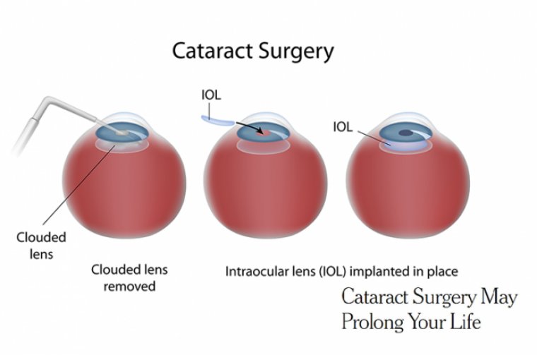 Cataract Surgery Prolongs Life