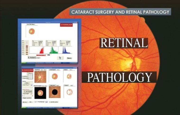 Cataract Surgery & Retinal Pathology