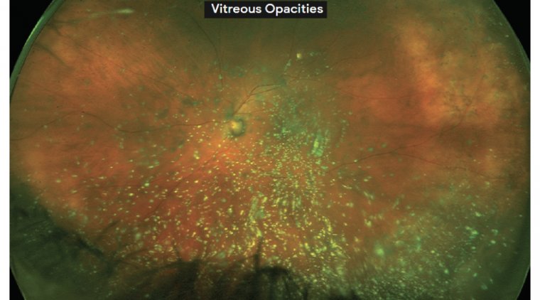 Cataract Surgery - Vitreous Opacities  & Retroillumination Techniques