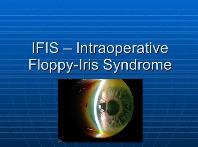 Cataracts & Floppy Iris Syndrome