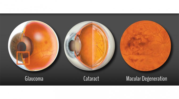 Cataracts to Macular Degeneration | Age-Related Eye Problems and Treatment