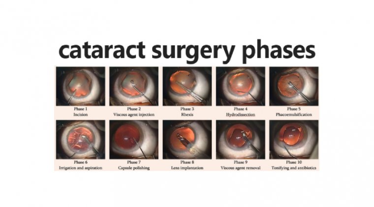 Combining Diagnostic Data to the OR in Cataract Surgery
