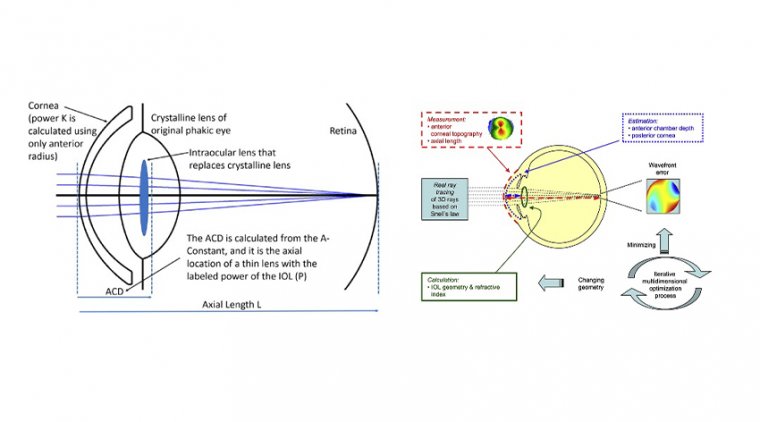 Complex Corneas – Cataract Surgery & IOL Selection for Already Aberrated Cornea 