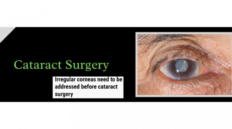 Corneal Surface Irregularities & Cataract Surgery 