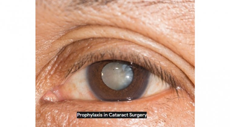 Dealing with Cataract Prophylaxis  
