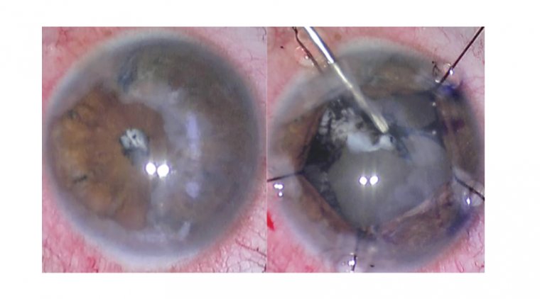 Dealing with Complex Pathology in Cataract Surgery