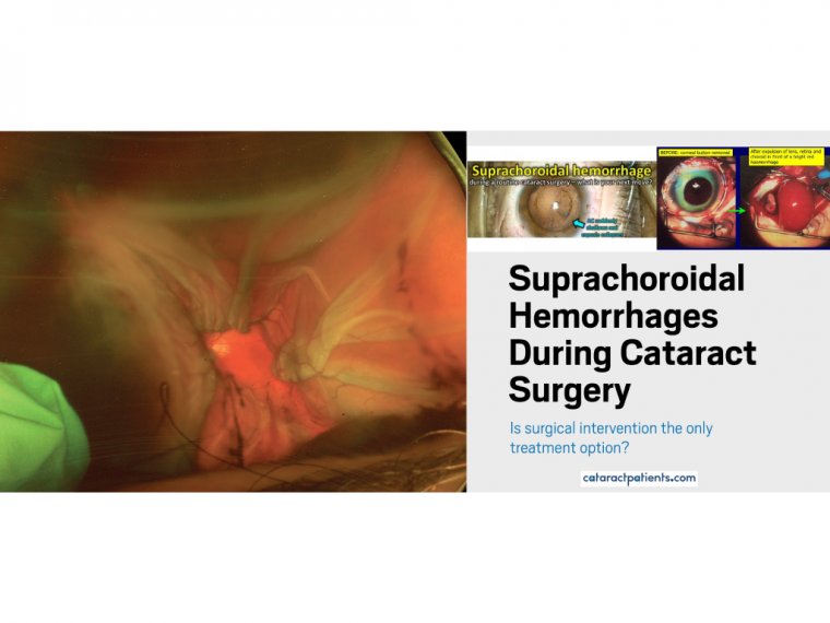 Dealing with Suprachoroidal Hemorrhages During Cataract Surgery 