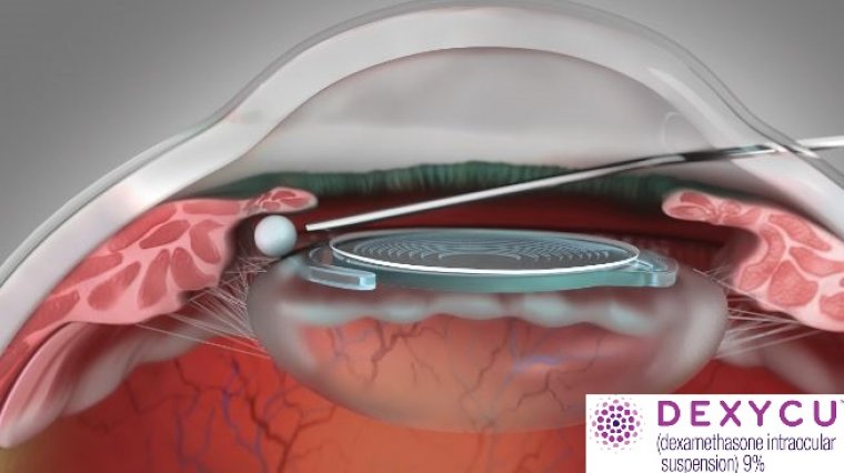 Dexamethasone Intraocular Suspension In Cataract Surgery
