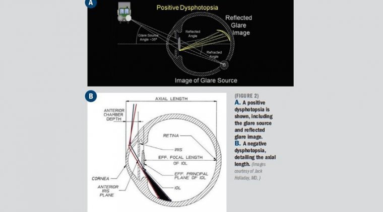 Dysphotopsia & Cataract Surgery