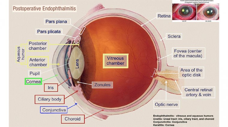 Endophthalmitis Risk After Cataract Surgery 