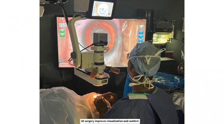 Facilitating Role of the 3D Viewing Systems in Cataract Surgery