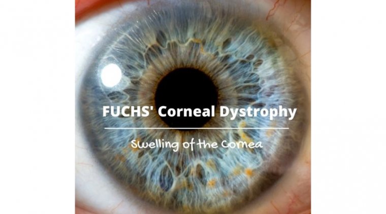 Cataract Surgery & Fuchs’ Endothelial Corneal Dystrophy (FECD)
