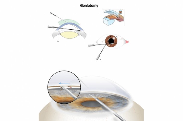 GONIOTOMY AND CATARACT SURGERY
