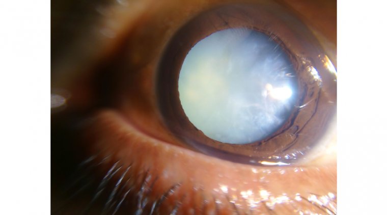 How To Deal With Dense Cataracts 