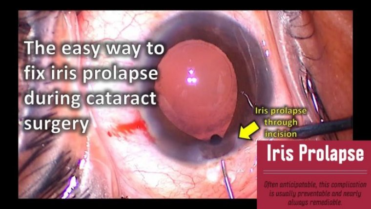 How To Manage Iris Prolapse During Cataract Surgery