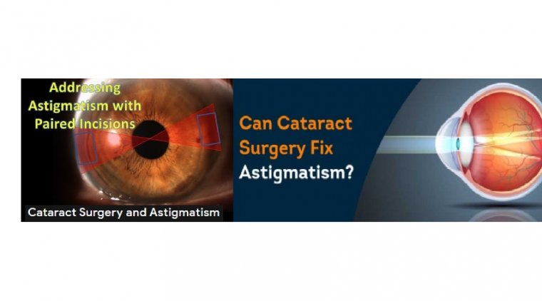How to Manage Irregular Astigmatism in Cataract Surgery 
