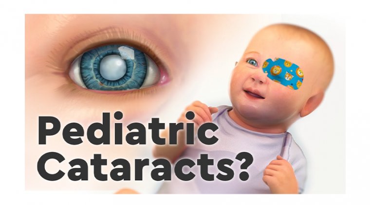 In Light of Preventing Posterior Capsule Opacification in Pediatric Cataract Surgery