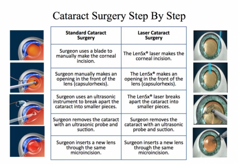 Information for Cataract Patients Undergoing Surgery
