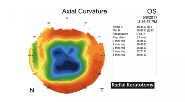Intraocular lens power calculation after radial keratotomy