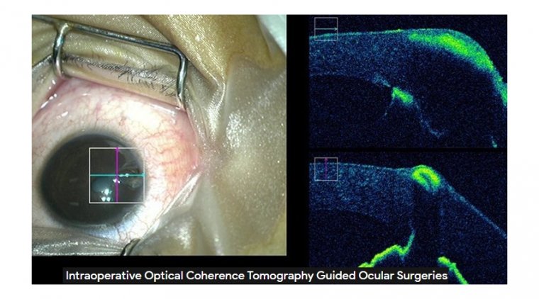 Intraoperative Optical Coherence Tomography in Cataract Surgeries 