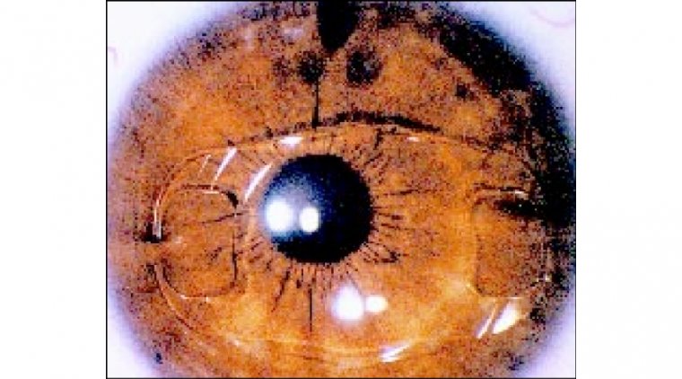 Iris Fixation IOL Technique in Cataract Surgery