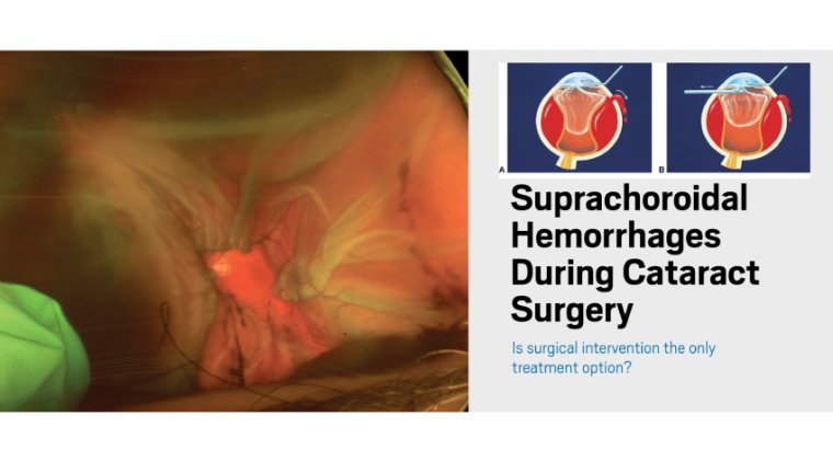 Management of Suprachoroidal Hemorrhage during Cataract Surgery