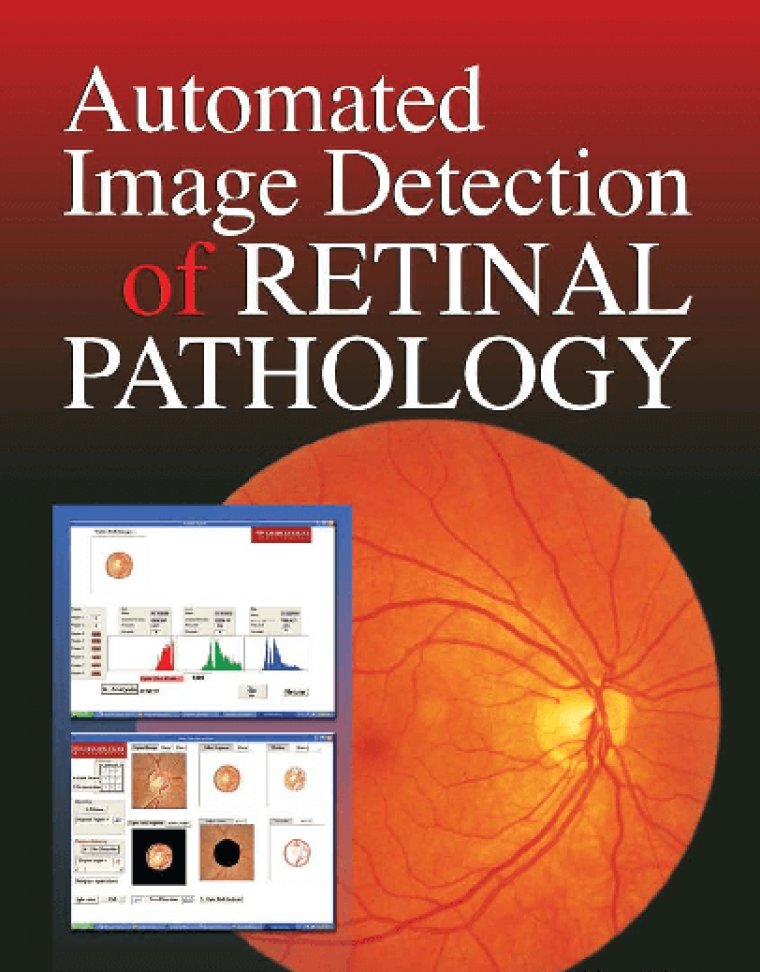 Pre–Existing Retinal Pathology in Preoperative Cataract Surgery Patients