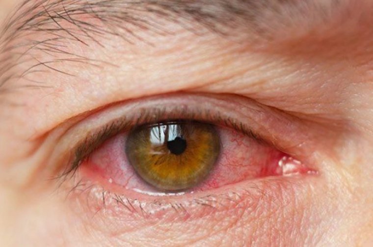 Refractive Cataract Patients & DED Treatment
