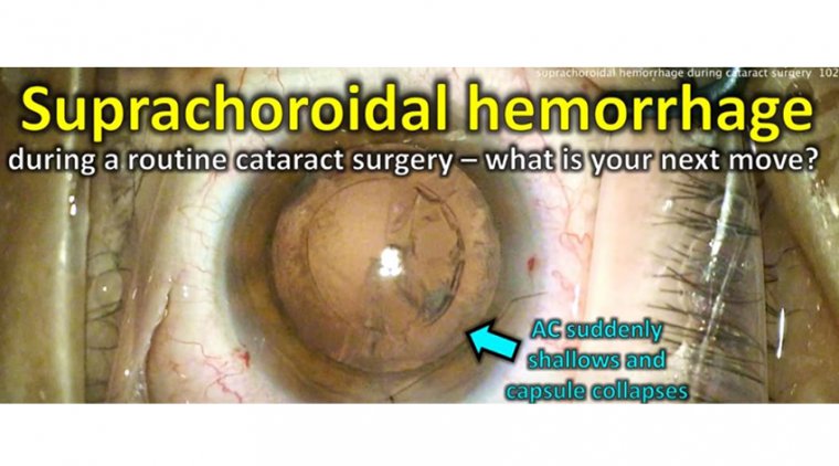 Suprachoroidal Hemorrhages During Cataract Surgery 