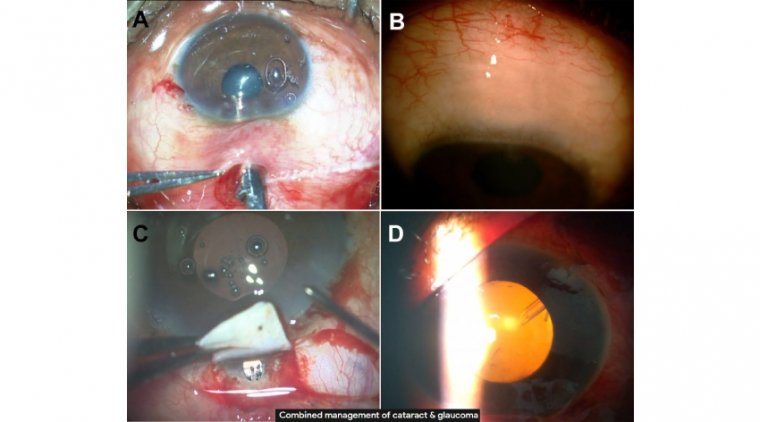 Techniques for Combined Cataract and Filtering Glaucoma Surgery