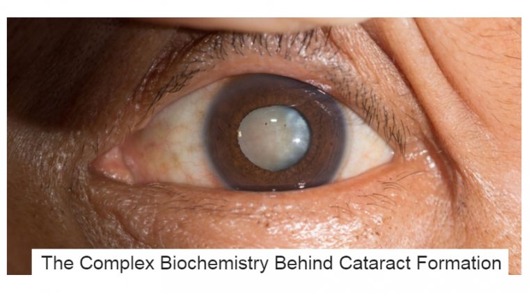The Complex Biochemistry Behind Cataract Formation