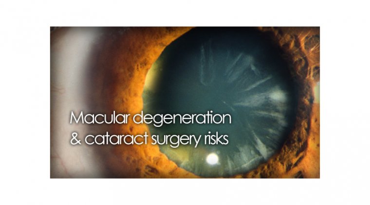 The Connection Between Cataracts & Macular Degeneration 