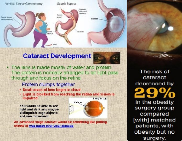 The Link Between Cataracts & Bariatric Surgery