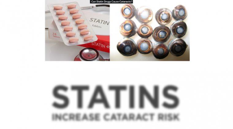 The Role of Statin Drugs Causing Cataracts
