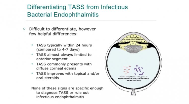 Toxic Anterior Segment Syndrome (TASS)