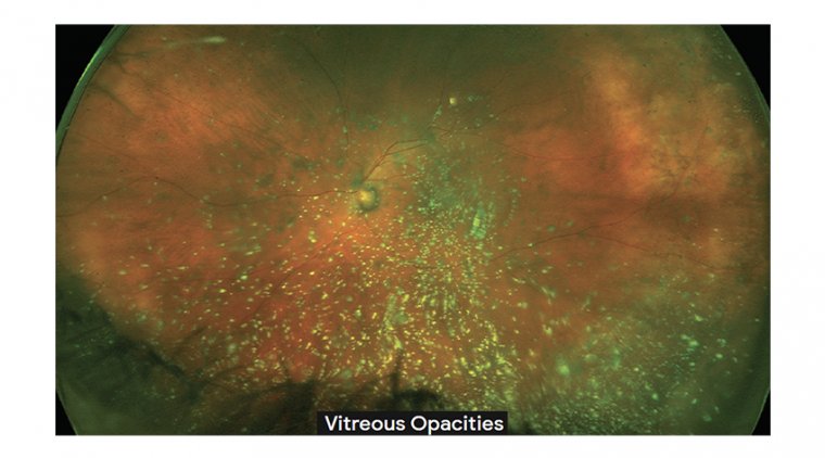 Vitreous Opacities During Cataract Surgery 